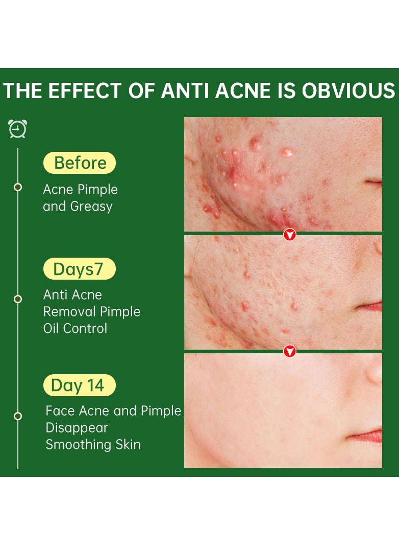 JoyPretty Acne Face Cream Herbal Pimple Scar Removal Shrink Pore Oil Control Moisturizing Facial Cream Acne Treatment Skin Care - Image 4