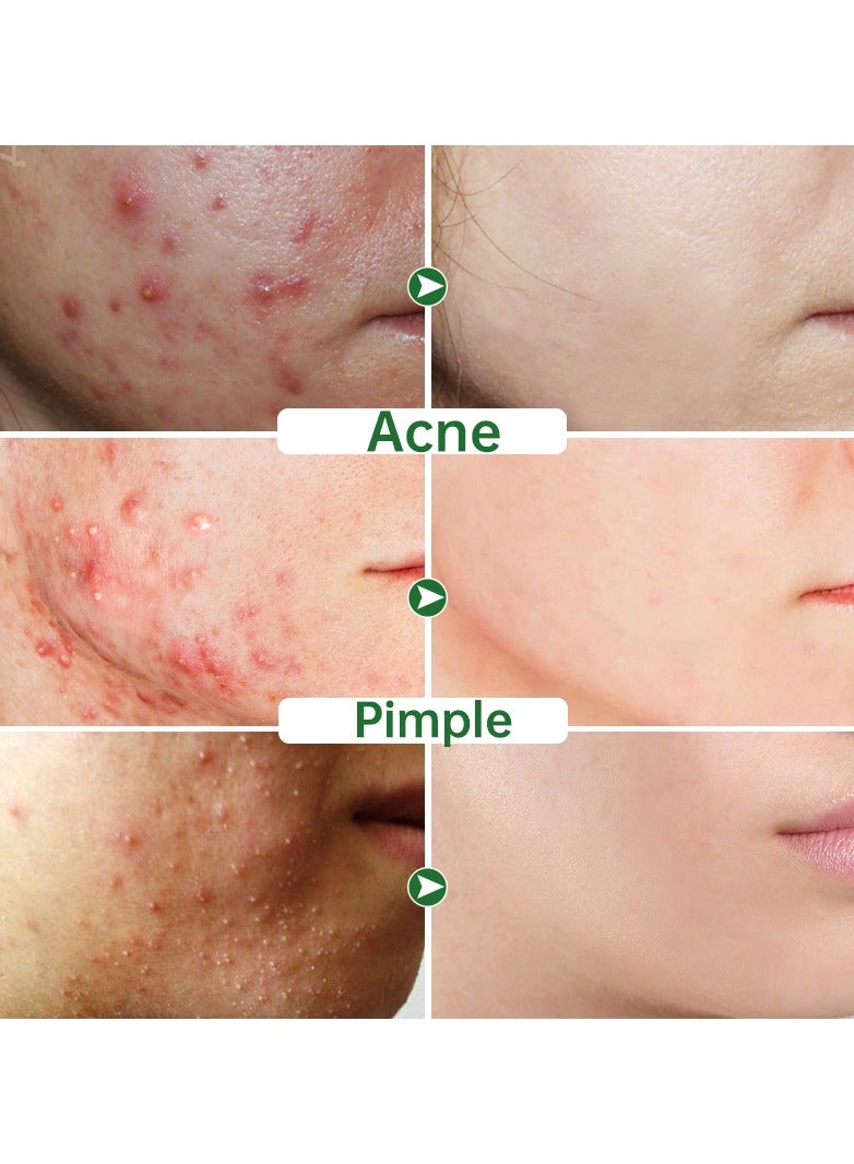 JoyPretty Acne Face Cream Herbal Pimple Scar Removal Shrink Pore Oil Control Moisturizing Facial Cream Acne Treatment Skin Care - Image 5