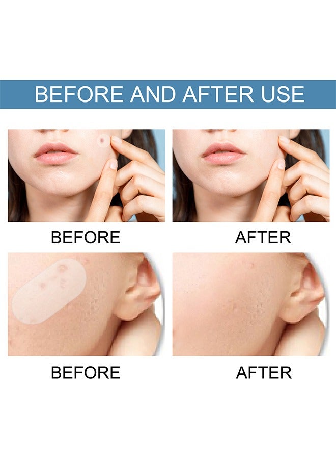 EELHOE Acne Patch - 5 Sizes Of Patch Healing Acne And Pustule Can Be Used Day And Night , Acne patch can be made up IOnvisible Acne-Clearing Anti-acne-Closing Acne Waterproof Concealer Hydrocolloidal Acne Patch 80 Patches - Image 4