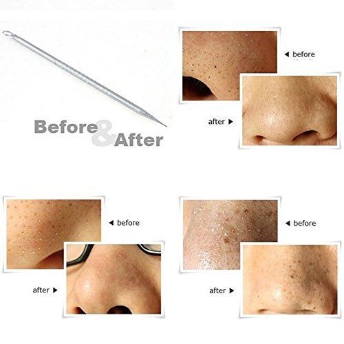 Out Of Box® Stainless Steel Blackhead Remover Needle (Pack of 4) - Image 3