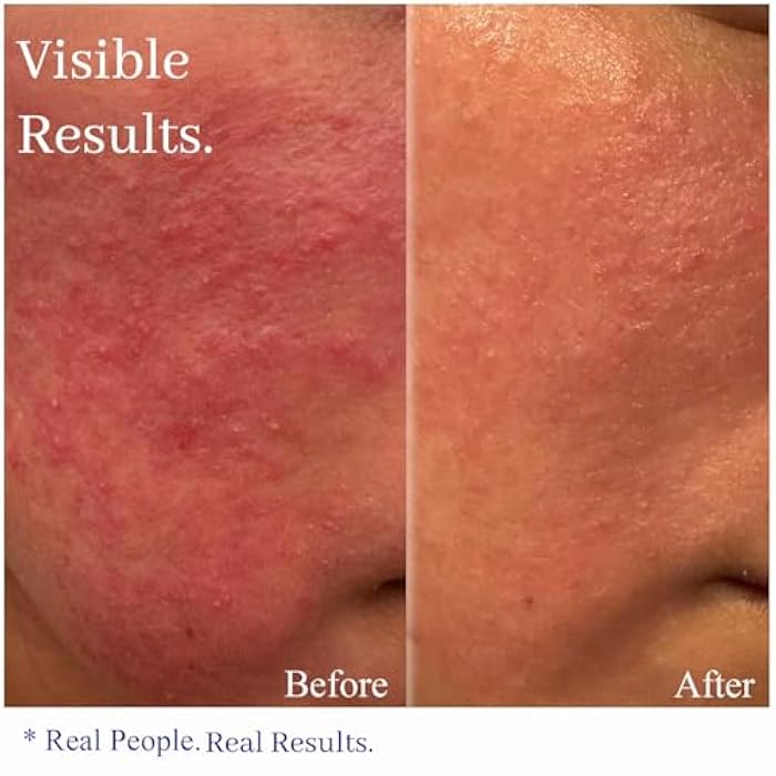 Hey Honey Skincare Relax - Instant Rosacea Relief Cream for Sensitive Skin | Calming Face Moisturizer for Facial Redness & Irritation | Dermatologist Tested, Oil-Free with Honey & Propolis | 2.2 Oz - Image 2