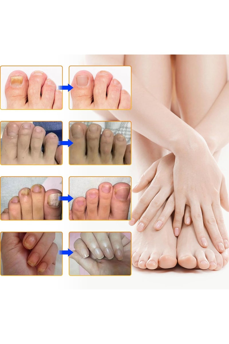 سيفودون علاج فطريات الأظافر القوة الإضافية - 32 قطعة فطريات الأظافر التصحيحات ، إصلاح الأظافر للأظافر المتضررة ، تجديد بين عشية وضحاها للرجال والنساء - Image 5