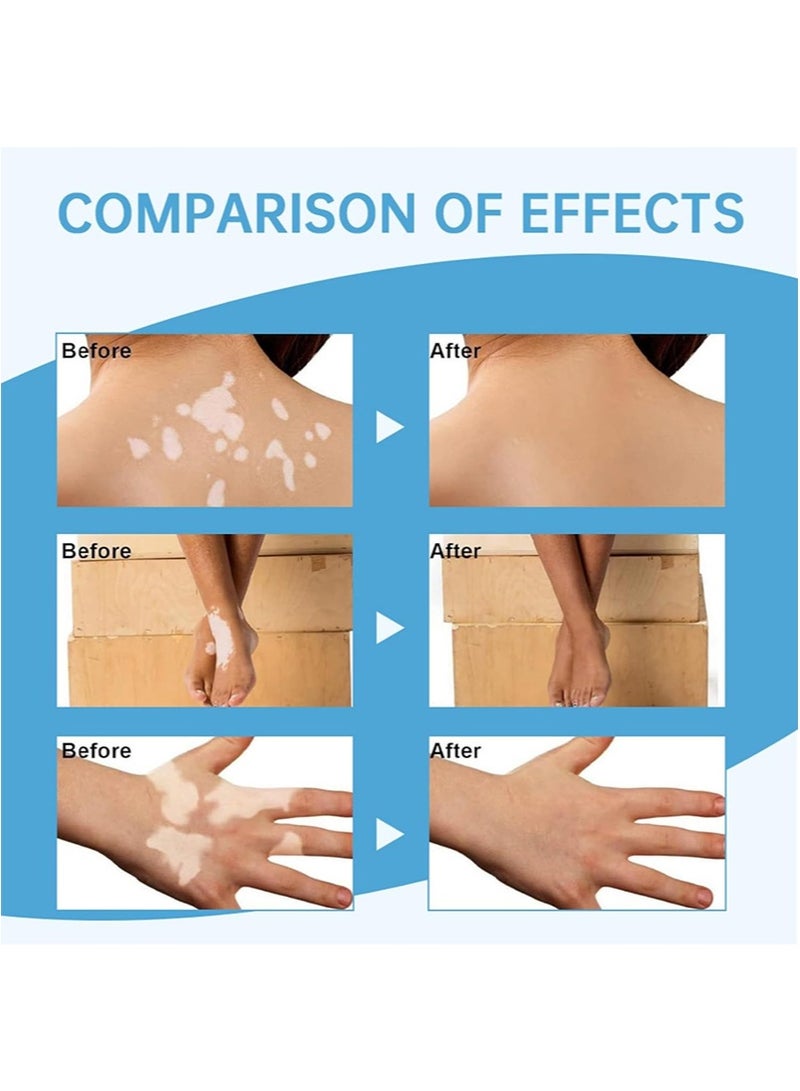 سوميفون بخاخ البهاق، علاج مرطب لإصلاح البشرة، للبقع البيضاء، النمش، بقع العرق، خلاصة للعناية بالبشرة لتحسين لون البشرة، وتعزيز صحة البشرة وتغذيتها (30 مل + 30 مل) - Image 3