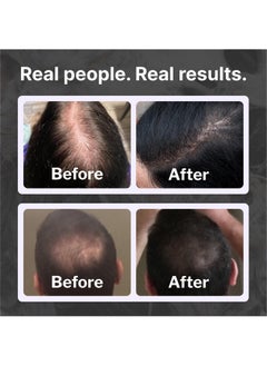 Shapiro MD Hair Growth Experts Hair Loss Shampoo Dht Fighting Vegan Formula For Thinning Hair Developed By Dermatologists Experience Healthier Fuller And Thicker Looking Hair 1 Month Supply  - Image 4