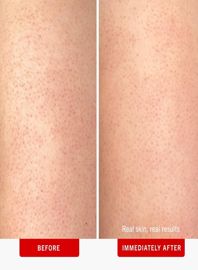 First Aid Beauty فيرست أيد بيوتي - مقشر الجسم لإزالة نتوءات كيرatosis Pilaris مع 10% AHA، مقشر للبشرة يحتوي على أحماض الجليكوليك واللاكتيك، يساعد في تقليل نتوءات جلد الدجاج، آمن للبشرة الحساسة، 2 أونصة، 3 قطع - Image 3