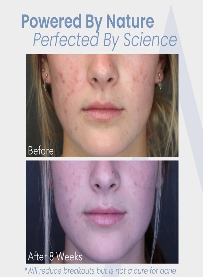 Augamis Hormonal Acne Treatment for Women - No DIM - (60 Capsules, 485 mg) – DIM-Free Acne Medication - Helps Nodular & Hormonal Acne - Best Acne Treatment for Teenagers & Adults - Image 4