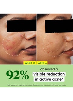 Dot & Key Dot & Key 2% Salicylic Acid + Cica Anti Acne Serum with Zinc | Salicylic Acid Serum for Acne and Dark Spots | Serum for Oily Acne Prone Skin & Sensitive Skin | Oil-Free & Non Comedogenic | 30 ml  - Image 3