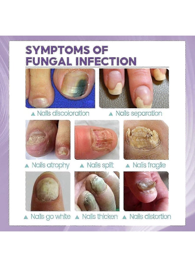 Jaysuing 100ml Nail Fungus Spray Soothing and Cooling Natural Anti-Fungal Nail Treatment Spray Effective Feet Infections Athlete Foot Nail Fungus Hand And Foot Care Fungi Spray - Image 5
