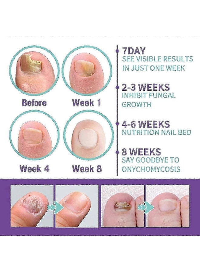 Jaysuing 100ml Nail Fungus Spray Soothing and Cooling Natural Anti-Fungal Nail Treatment Spray Effective Feet Infections Athlete Foot Nail Fungus Hand And Foot Care Fungi Spray - Image 4