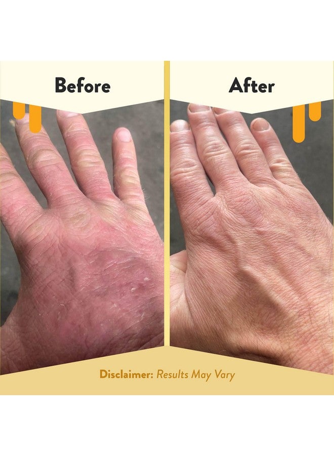 ECZEMA HONEY Gentle Foaming Hand Soapgentle Cleanser For Dry Handsnontoxic Unscented Hand Soapnatural Hand Cleaner For Bathroom & Kitchenorganic Honey Handwash (8.4 Oz) - Image 4