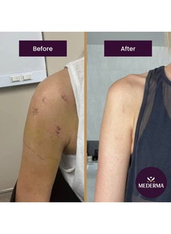 ميديرما جل Mederma Advanced Scar Gel 1x Daily يقلل من ظهور الندبات القديمة الجديدة العلامة التجارية الأولى الموصى بها من قبل الأطباء والصيادلة للندبات 1.76 أونصة، شفاف، 100 جرام (2 × 50 جرام)  - Image 5