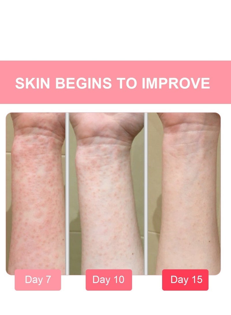 Sumifun Extra Strength Calamine Eczema Relief Cream, Promote Skin Health, Effective Relieve Itchy Inflamed ,Relieve Rosacea Vs Eczema Nourishing  Repairing Skin 20g - Image 3