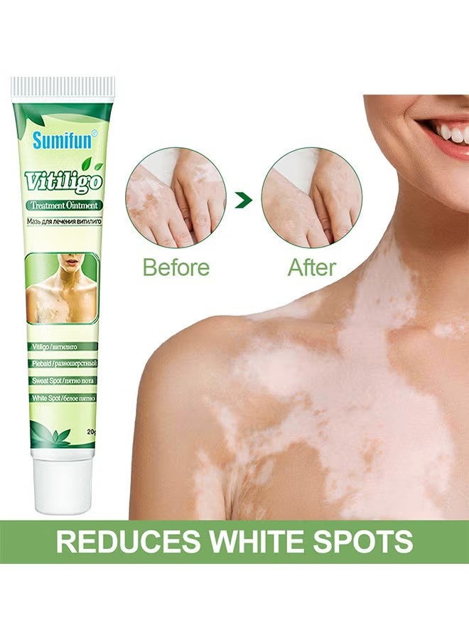 سوميفون مرهم علاج البهاق ، يقلل من البقع البيضاء على الجلد ، ينظم التصبغ ، يحسن تصبغ الجلد ، يقلل من البقع البيضاء على الجلد والبهاق كريم للعناية بالبشرة ، 20 جرام - Image 2