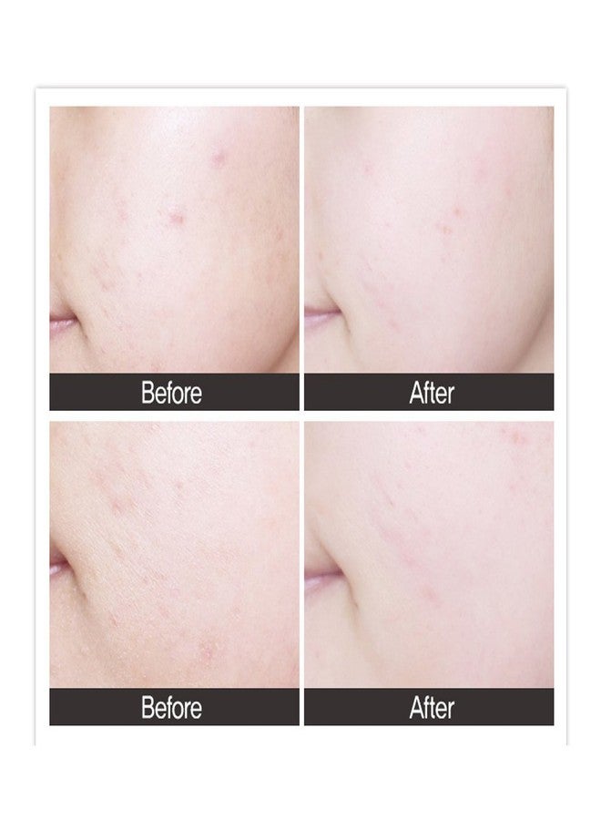 CRAZY SKIN سيروم أمبول مركز سنتيلا تيكا 3.4 أونصة سائلة (100 مل) - مكونات طبيعية للبشرة التالفة والمضطربة والحساسة، تخفيف الاحمرار، سيروم حمض ماديكاسيك للوجه مصنوع في كوريا - Image 5