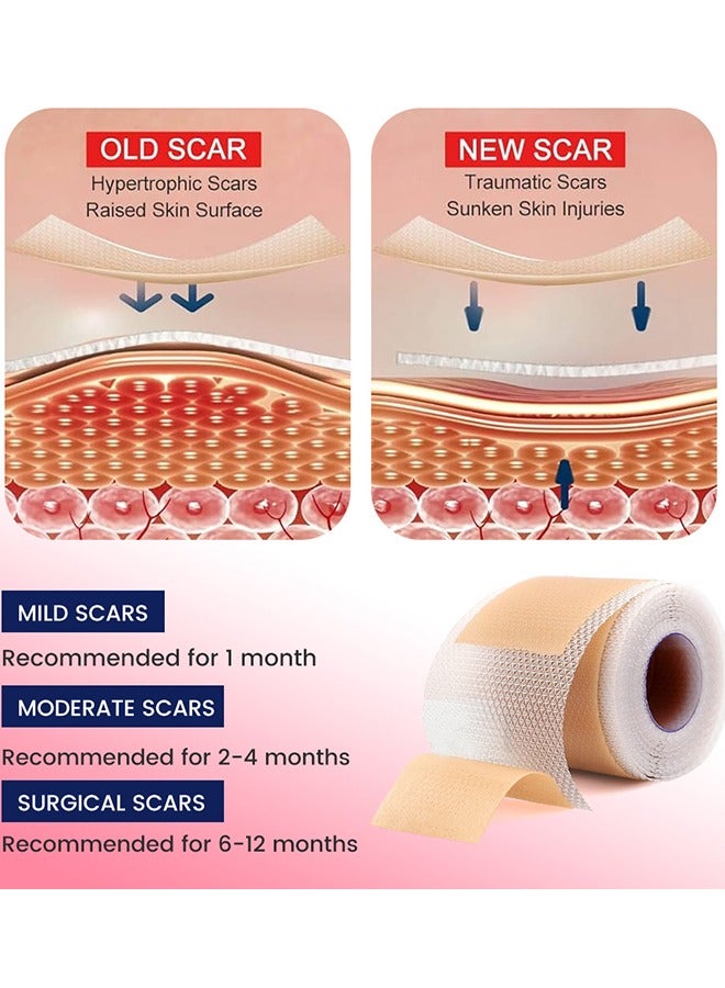 سوميفون شريط السيليكون الناعم لدرجة عالية من الراحة وغير مؤلم 6-8 أشهر تزويد حب الشباب ندبة C-قطاع جراحة الندبة الندبة المستشفى عالي المستوى الطبي (4cm x 150cm) - Image 4