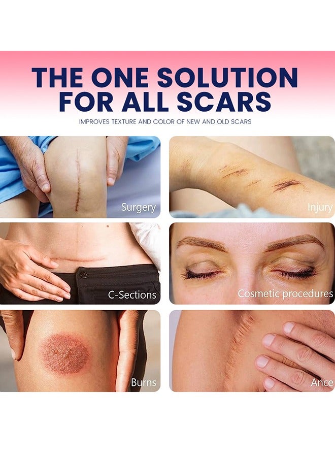 سوميفون شريط السيليكون الناعم لدرجة عالية من الراحة وغير مؤلم 6-8 أشهر تزويد حب الشباب ندبة C-قطاع جراحة الندبة الندبة المستشفى عالي المستوى الطبي (4cm x 150cm) - Image 5