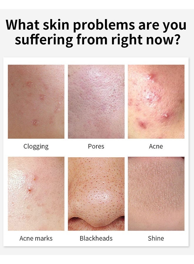 Youbuy جل لإزالة حب الشباب وعلاج الرؤوس السوداء للاستخدام اليومي يزيل حبوب الوجه ويعالج الرؤوس السوداء بحمض الأزيليك، يتحكم في الزيت، يقلص المسام، يخفف الاحمرار، يفتح البشرة، كريم لتلاشي الندوب وكريم مزيل حب الشباب 20 غ - Image 2