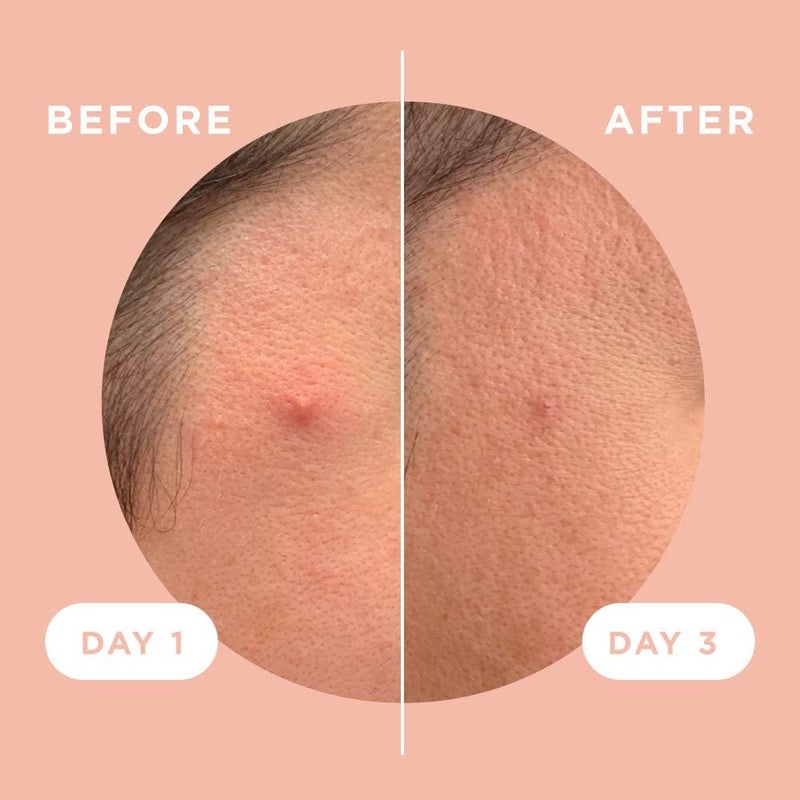 ZITSTICKA مجموعة ZitSticka Killa | رقعة علاج حب الشباب ذاتية الذوبان من Microdart لعلاج البثور والبقع | استهداف البقع العمياء في مرحلة مبكرة والتي يصعب الوصول إليها للوجه والبشرة (عبوة من 4 قطع) - Image 5