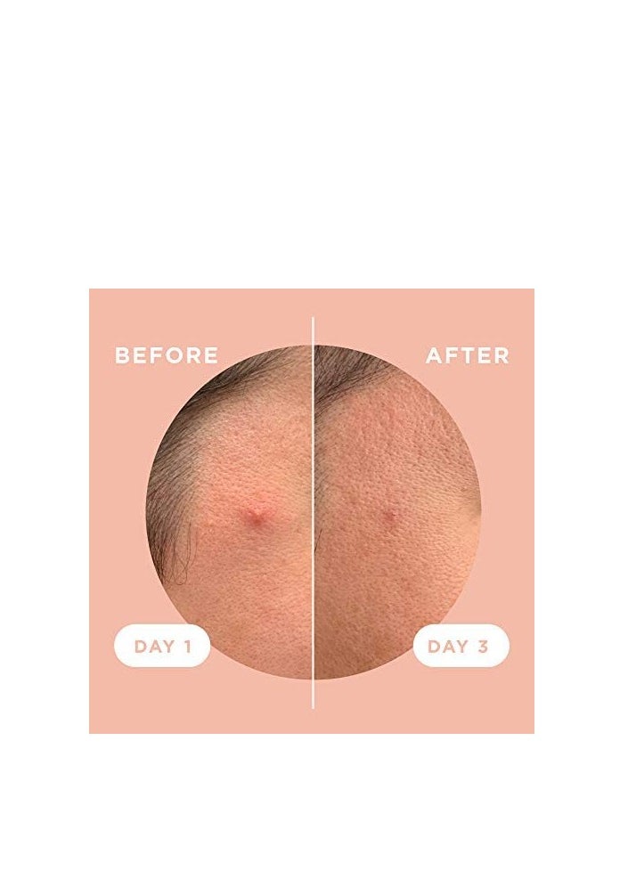 ZITSTICKA - ZitSticka Killa Kit | Self-Dissolving Microdart Acne Pimple Patch for Zits and Blemishes | Spot Targeting for blind, early-stage, hard-to-reach zits for Face and Skin (4 Pack) - Image 1