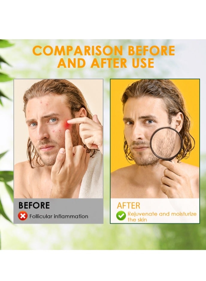 سوميفون كريم بصيلات الشعر، بصيلات شعر فروة الرأس وبصيلات الشعر المصابة بحب الشباب، علاج للوجه والجسم، علاج طبيعي لحب الشباب الكيسي، كريم بصيلات الشعر الفاخر ومزيل البثور - 20 جرام - Image 4