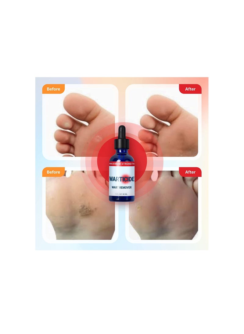 WARTICIDE - Fast Acting Wart Remover Plantar and Genital Wart Treatment - Image 1