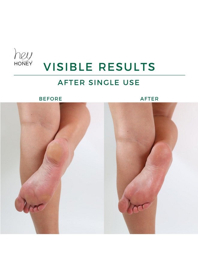 Hey Honey Walk The Walk Propolis Foot & Cracked Heel Cream For Extremely Dry Feet & Cracked Heels Callus Remover For Feet Lasting Effect Up To 72 Hours Infused With Honey And Urea 5 Oz - Image 3