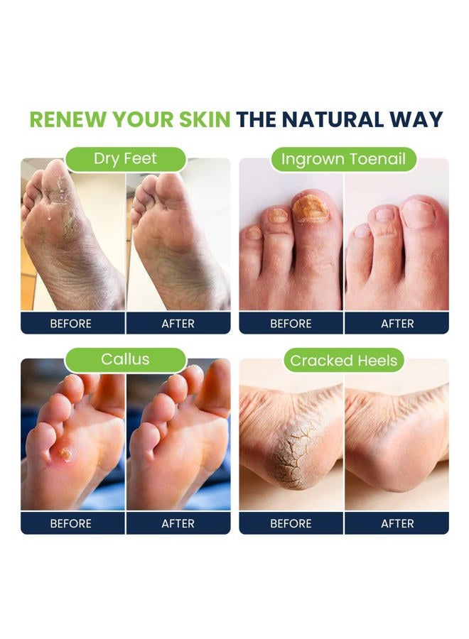 Foot Cure نقع القدم بزيت شجرة الشاي مع ملح إبسوم - لإصلاح أظافر القدم، قدم الرياضيين، تليين الكالو، تهدئة الأقدام المتعبة والمؤلمة، تغير لون الأظافر، رائحة عطرية، عناية باديكير سبا - صنع في الولايات المتحدة 16 أونصة - Image 4