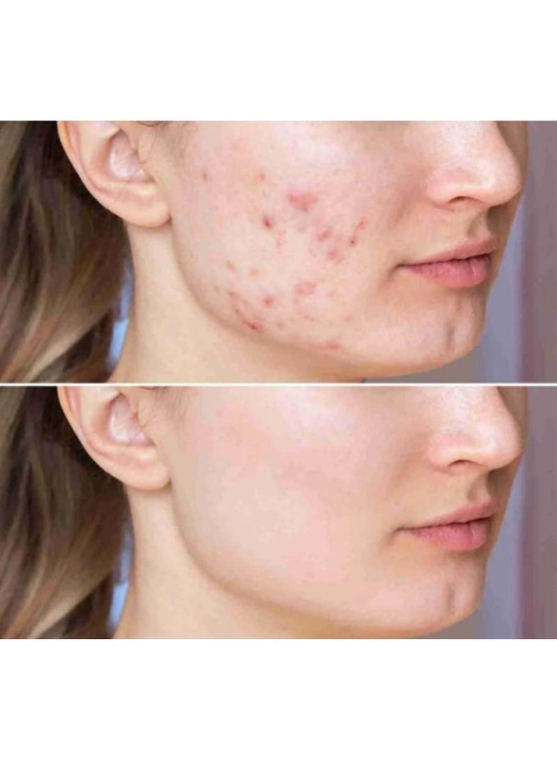 Pharma Acretin for Acne Treatment 30g - Image 4