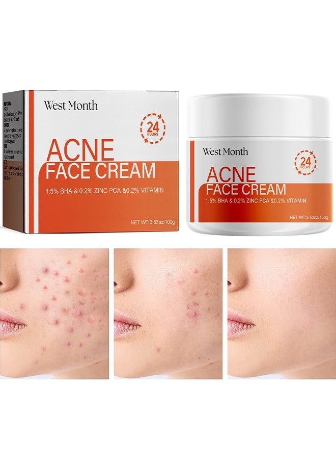 West&Month Acne Face Cream, Acne Spot Treatment For Face And Acne Dots, Natural Cystic Acne Treatment, Acne Moisturizer, Premium Acne Scar Cream And Pimple Remover 100G  - Image 1