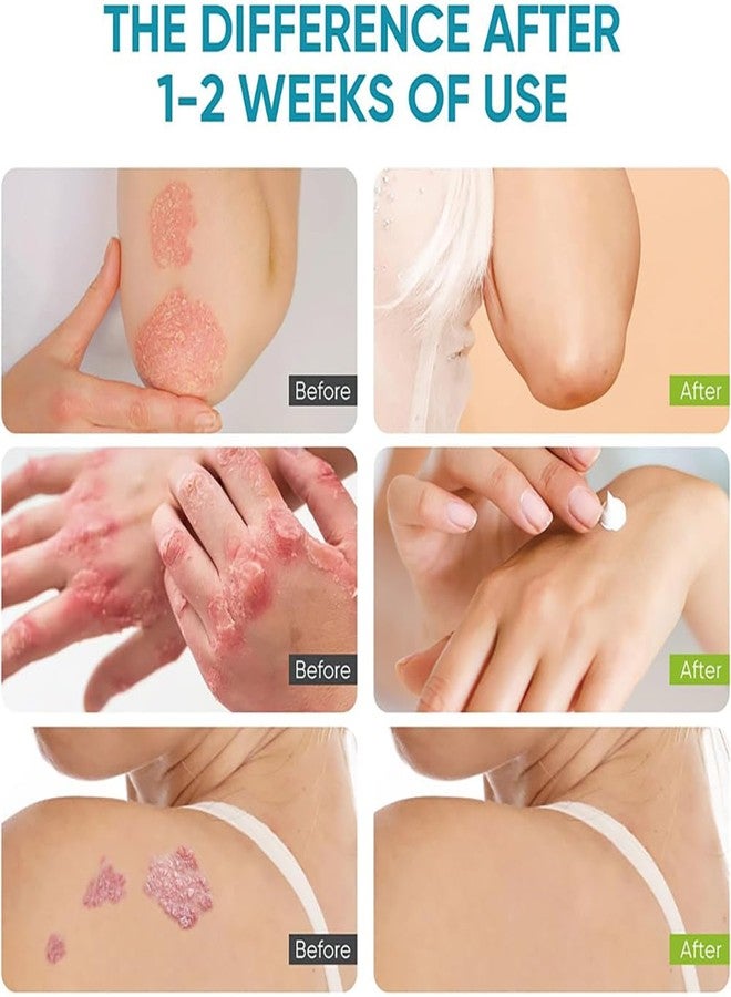 YURHERSU كريم يورهيرسو لمرض الصدفية مضاد للحكة يساعد في تخفيف الحكة والاحمرار والتقشر والتهيج وقشرة الرأس وتقشر الصدفية والتهاب الجلد الدهني غير لزج مرطب سهل الامتصاص للعناية اليومية بالبشرة - Image 4