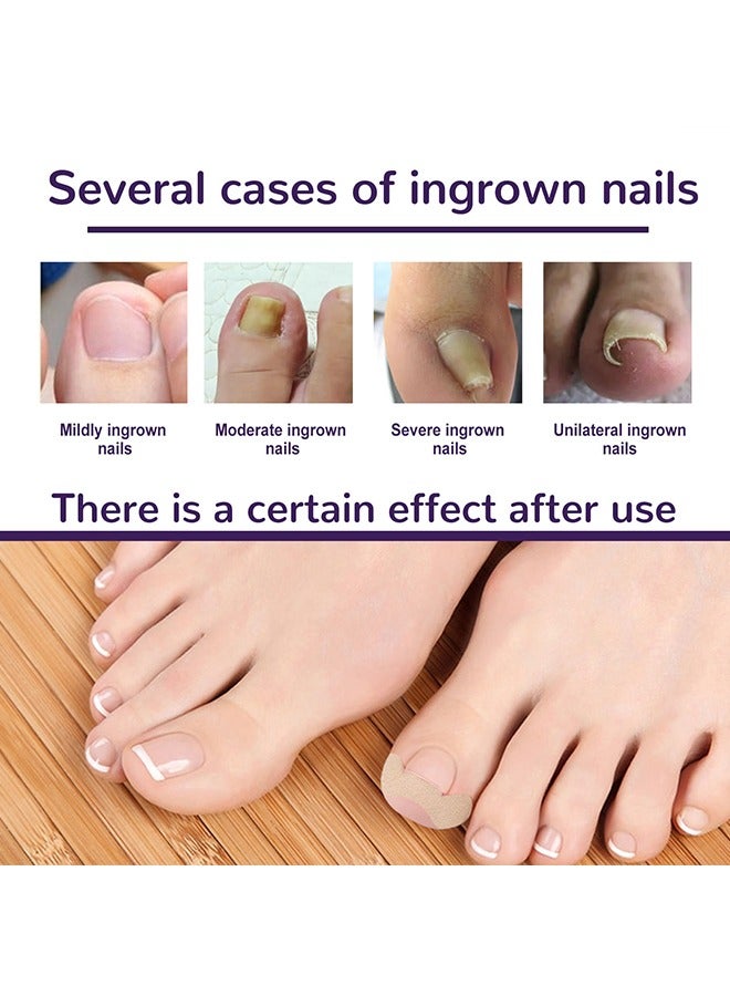 إيلهو رقعة مصحح أظافر نام ، شرائط مصحح أظافر نام ، رقعة مصحح أظافر ، أداة ملصقات تصحيح أظافر مرنة ذاتية اللصق ، تخفف من آلام أخدود أظافر القدم (50 قطعة) - Image 4