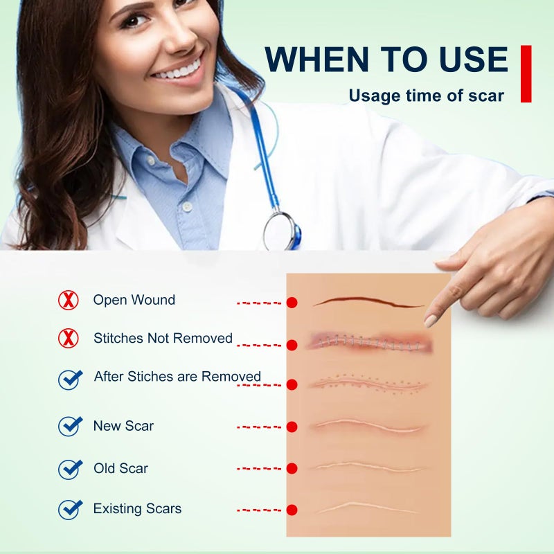 ZODENIS شرائح سيليكون لعلاج الندبات (1.6 بوصة × 120 بوصة - لفة 3M)، لفة شريط سيليكون للندبات، شرائح سيليكون للندبات، قابلة لإعادة الاستخدام، شرائح احترافية لإزالة الندبات للولادة القيصرية، الجراحة، الحروق، الكيلويد، حب الشباب وما إلى ذلك. - Image 5