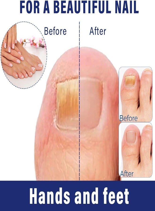 SYLVERA Nail Softener & Ingrown Toenail Relief Drops | Helps Ease Pain, Swelling & Discomfort | Daily Nail Care Solution 30ml (Pack Of_1) - Image 3