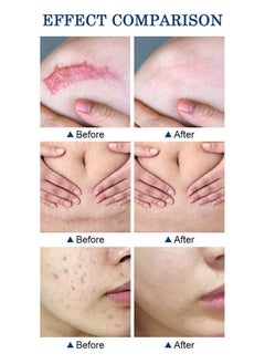 MOOYAM Scar Removal Cream, Skin Repairing Cream Fade Scars/Stretch Marks/Acne Treatment, Improve Scar Skin, Deeply Moisturizes Skin  - Image 5