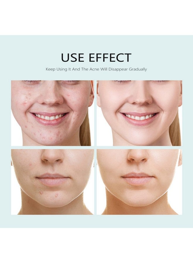 YAFUSIPE Facial Mask Anti Acne Face Masks Skin Care, Sheet Masks With Salicylic Acid Sheet For Acne Prone Hydrating Moisturizing Skincare for Scar Breakouts Pimple Beauty Oil Control Redness 10 Sheets - Image 2