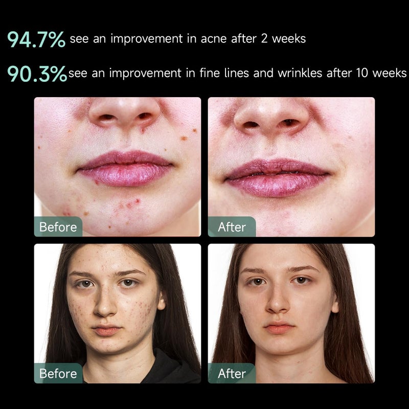 AphronaÂ® | FDA cleared Moonlight LED Facial Mask Skin Care Mask, LED Light Therapy Red Blue light for Acne Removal Wrinkle Reduction - Image 3