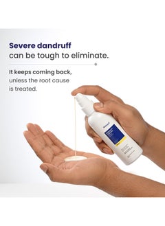 RE' EQUIL Dandruff Control Lotion (Pre Wash) | Reduces Severe, Greasy, And Flaky Dandruff | Reduces Dryness & Itching | No Drip Formulation | All Hair Types | 100Ml  - Image 2