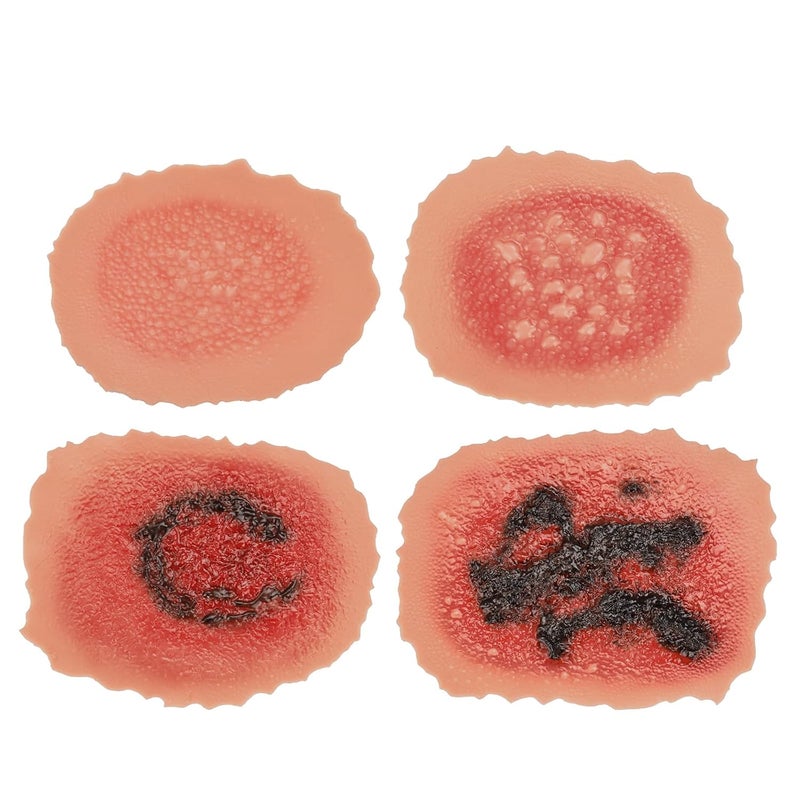 MedEduQuest Burn Wound Packing Trainer Burn Moulages Kit Adhesive Skin Burn Wound Trainer for Wound Care Training Burn Wound Training Model - Image 1