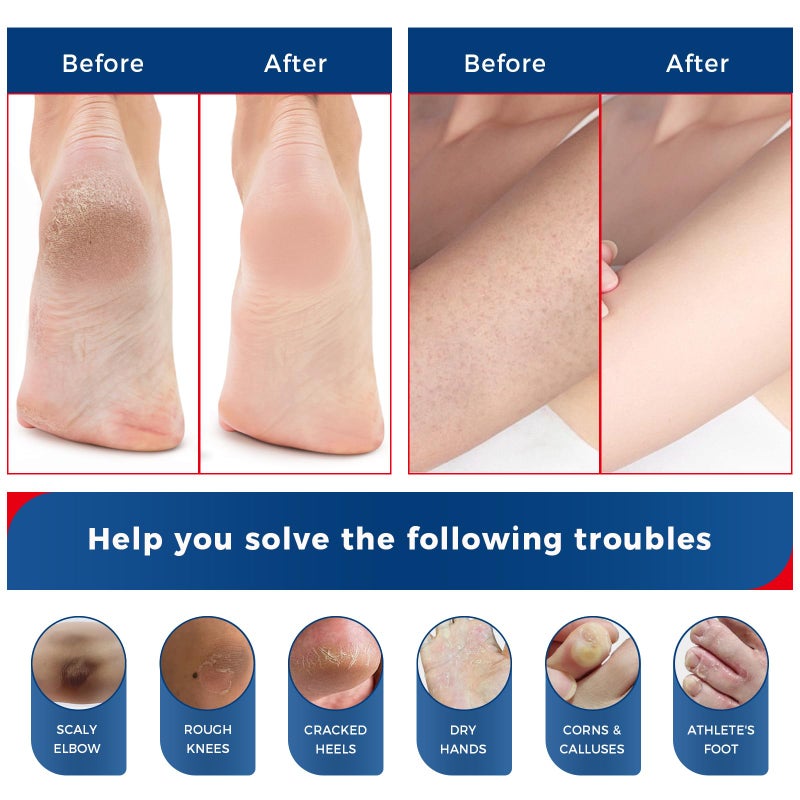 OUKEYA NEW FORMULA Urea Cream 40% Plus 2% Salicylic Acid for Feet Maximum Strength, Dry Cracked Hand Heel Moisturizing Repair Lotion for Knees, Elbows, Removes Corns, Dead Skin Cream, 5.29 oz 2 Pack - Image 5