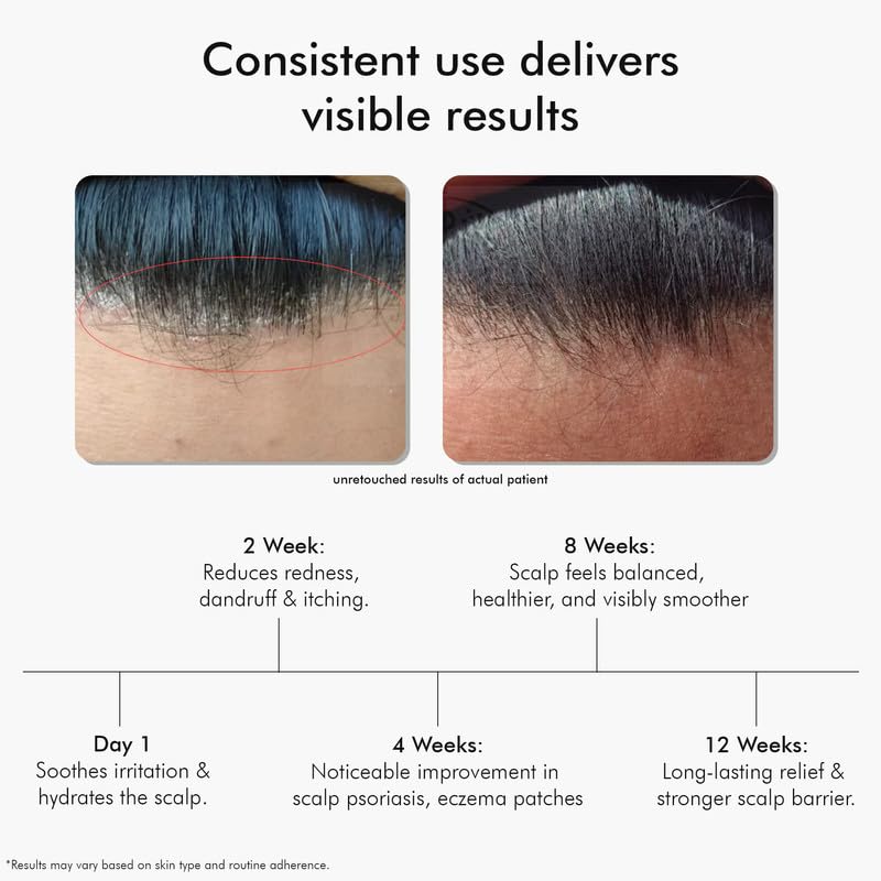 VEDICDERM Plasma Bamboo Charcoal Shampoo 200ml Clinically Proven For Scalp Psoriasis Dandruff Sensitivity Relieves Itching Flaking Dryness SLS Paraben Irritants FreeDaily Hair Cleanser - Image 2