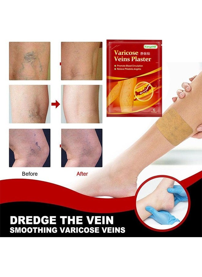 KanyeHB - Varicose Veins Treatment Patch For Legs, Promote Metabolism And Improve Blood Circulation, Relief Heavy Tired Leg 12PCS - Image 1