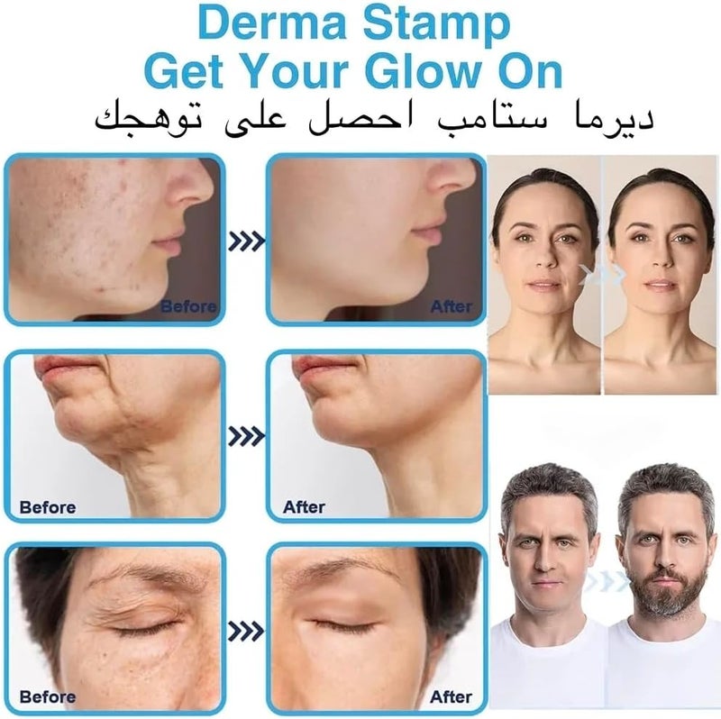 Derma Stamp, Beard Growth Micro Elegant Pen for Hair and Beard Growth, Lightweight, Micro Needle Stamp 0-3 Mm, 140 Grade A Titanium Needles, Dermastamp Adjustable - Image 2