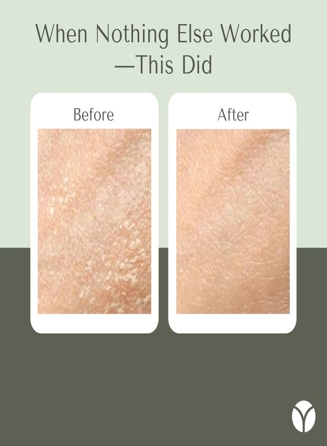Yobee Body & Face Cream for Dry, Itchy Skin, Eczema & Psoriasis, Dermatologist Formulated, Probiotics, Honey, Turmeric, Vitamins B12 & E, Ceramides, Shea Butter, Fragrance Free, For Kids & Adults - Image 3