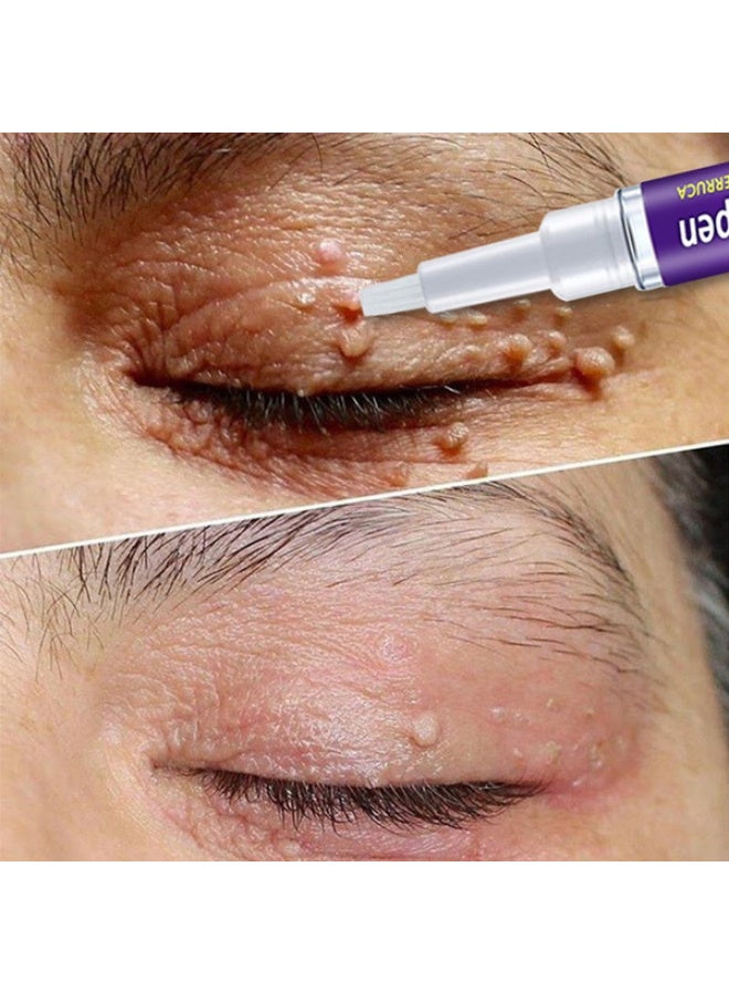 إيلهو كريم إزالة الورم مع قلم إصلاح الورم العناية بالبشرة إزالة الورم مزيل الورم علاج الورم إزالة الورم الصغير ضد الورم - Image 3