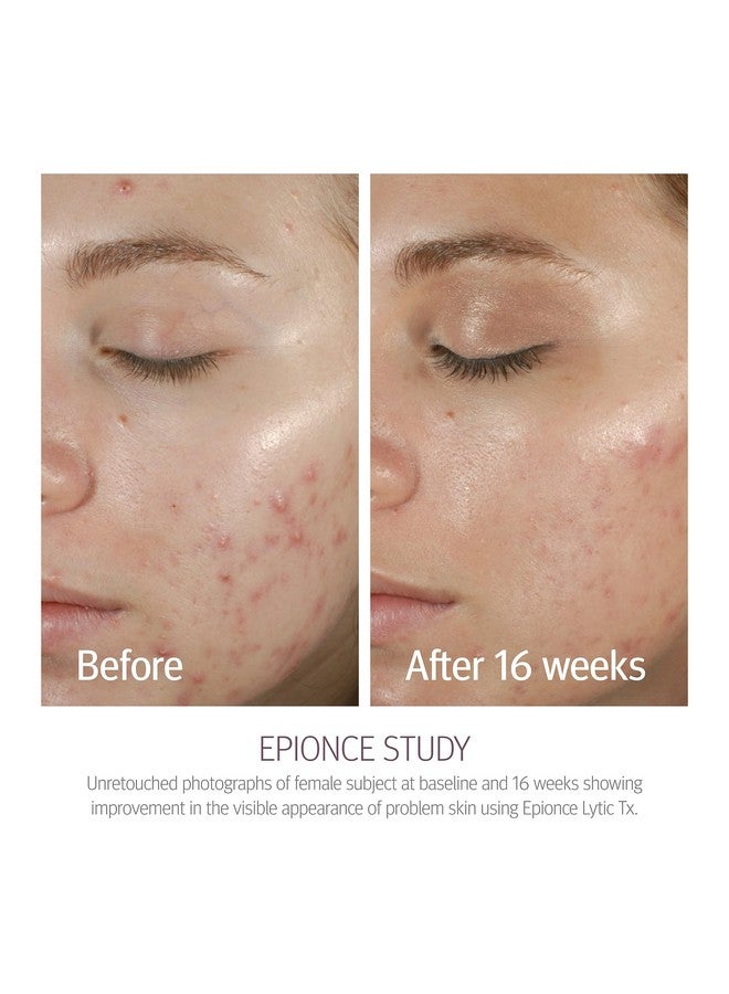Epionce Lytic Tx - Normal to Combination Skin Moisturizer for Face, Salicylic Acid, Azelaic Acid & Hyaluronic Acid Texture, Breakout, & Pore Minimizer - Image 4