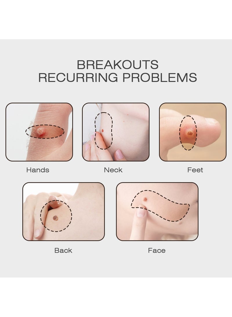 سوميفون كريم إزالة الثآليل، مزيل الثآليل للثآليل الأخمصية، الثآليل الشائعة، مسامير القدم، كريم الثآليل 20 جرام - Image 5