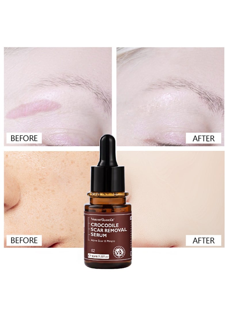 Vibrant Glamour 30ml Crocodile scar removal serum, crocodile scar removal serum, pigmented acne treatment stretch mark removal - Image 2