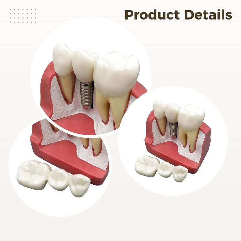 Enlarged Dental Implant Model, 4X Crown and Bridge, Detachable Restorations, 6.3X3.1X2.9 in - Image 2