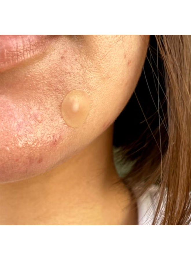 Peace Out Jumbo Acne Dots (40 Dots) - Image 3