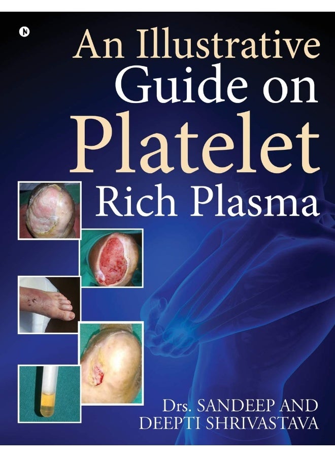 An Illustrative Guide on Platelet Rich Plasma 